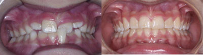 Crossbite, Eruption Problems